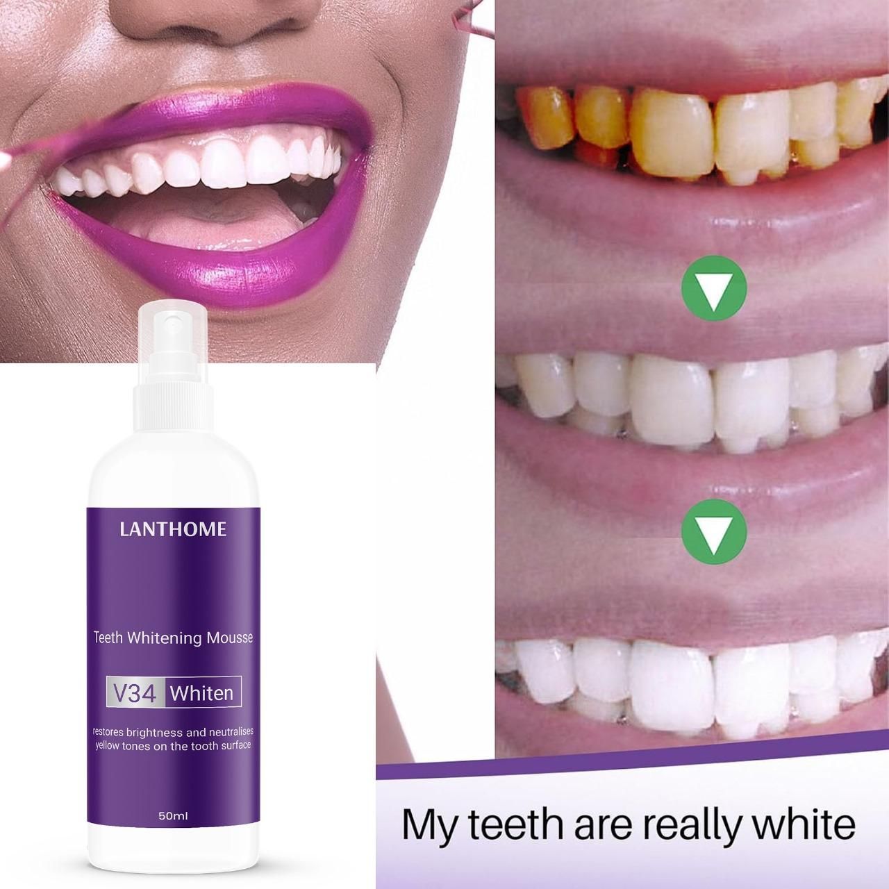 Lanthome Teeth Whitening Mousse V34 Whiten 50ml – Daily Use Tooth Foam for Stain Removal & Bright Smile (Pack of 1/2) | SFYKART